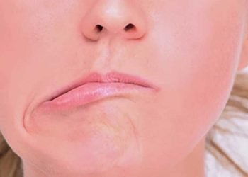 ¿Cómo empieza la parálisis facial por estrés?