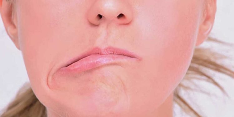 ¿Cómo empieza la parálisis facial por estrés?