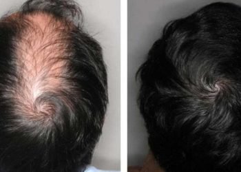 ¿Cómo hacer crecer el cabello de forma natural para hombres?