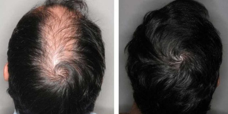 ¿Cómo hacer crecer el cabello de forma natural para hombres?