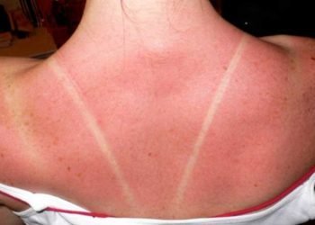 ¿Cómo recuperar el color de la piel quemada por el sol?