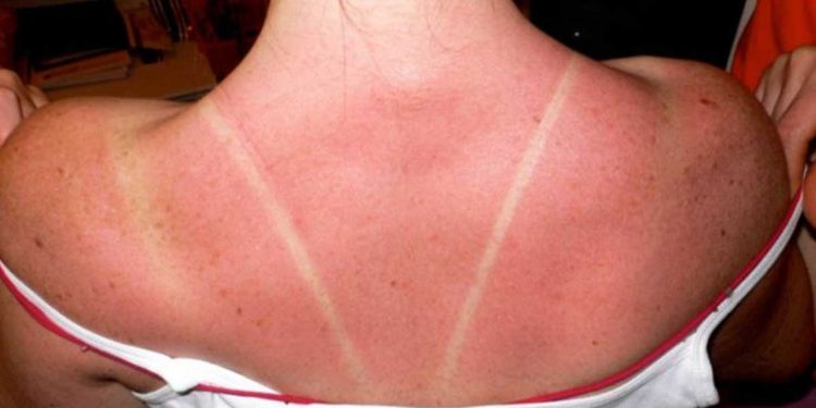 ¿Cómo recuperar el color de la piel quemada por el sol?