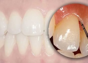 ¿Por qué sale el sarro en los dientes?