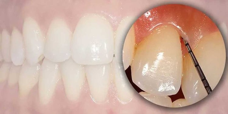 ¿Por qué sale el sarro en los dientes?