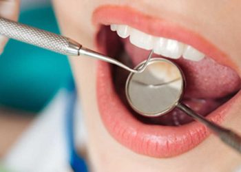 ¿Por qué se caen las resinas dentales?