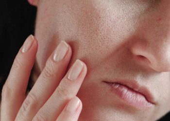 ¿Por qué se producen los poros abiertos?