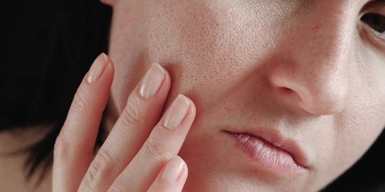 ¿Por qué se producen los poros abiertos?