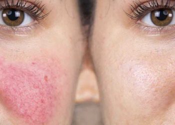 ¿Qué activa la rosácea?