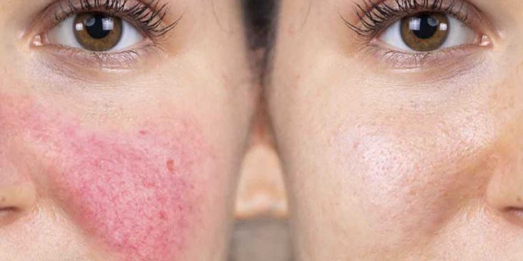 ¿Qué activa la rosácea?