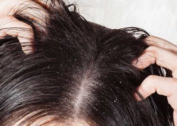 ¿Qué empeora la caspa?