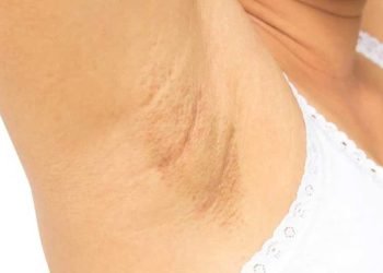 ¿Qué es lo que oscurece las axilas?