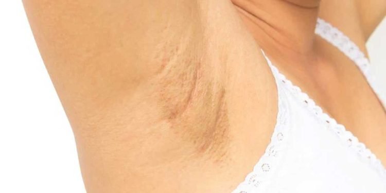 ¿Qué es lo que oscurece las axilas?