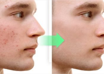 ¿Qué hace la sábila en el acné?