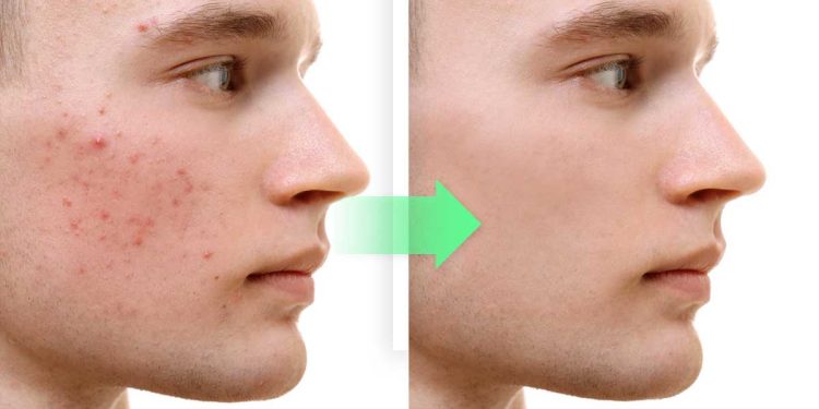 ¿Qué hace la sábila en el acné?