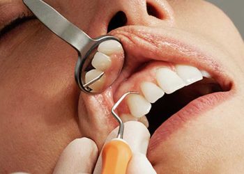 ¿Qué pasa si el empaste toca el nervio?