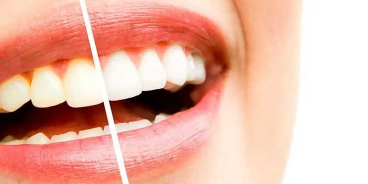 ¿Qué pasta de dientes es buena para blanquear los dientes?