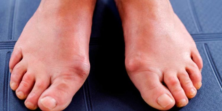 ¿Cómo empieza la diabetes en los pies?