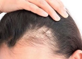 ¿Cuánto tiempo dura la caída del cabello por estrés?