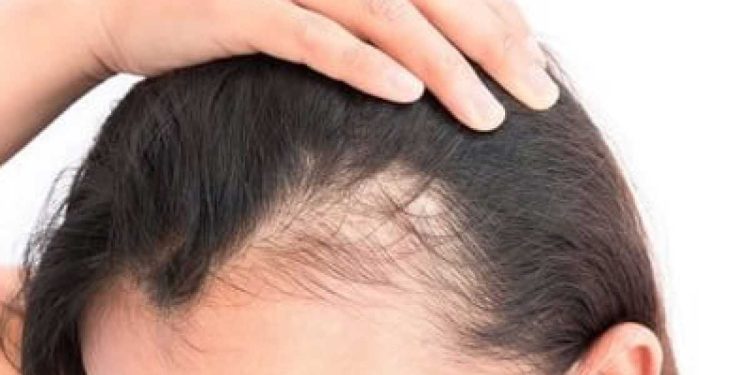 ¿Cuánto tiempo dura la caída del cabello por estrés?