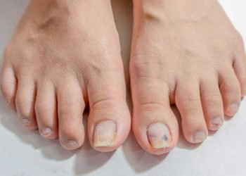 ¿Por qué se producen los hongos en los pies?