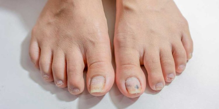 ¿Por qué se producen los hongos en los pies?